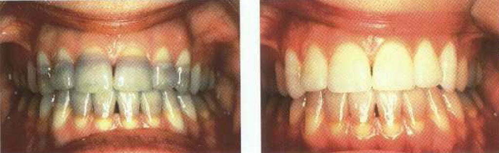 تغییر رنگ ذاتی دندان ها