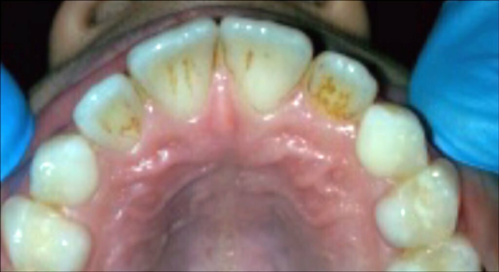 عوامل تغییر رنگ خارجی دندان