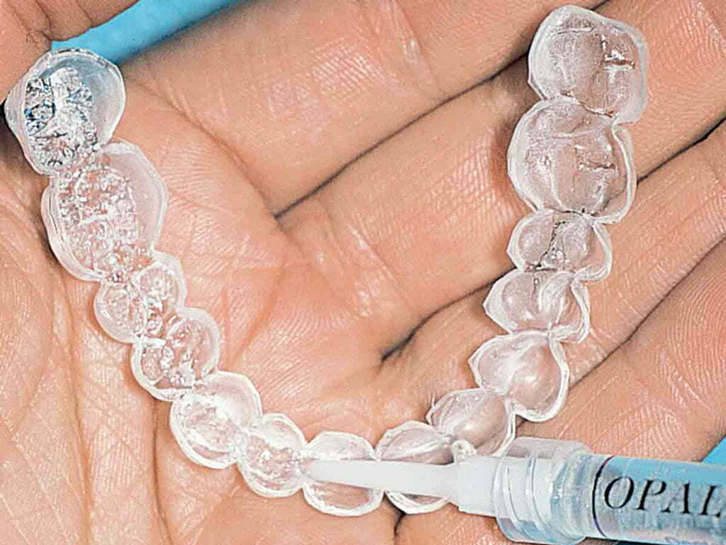 قالب دندان بلیچینگ