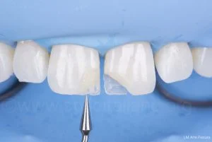 دندان شکسته