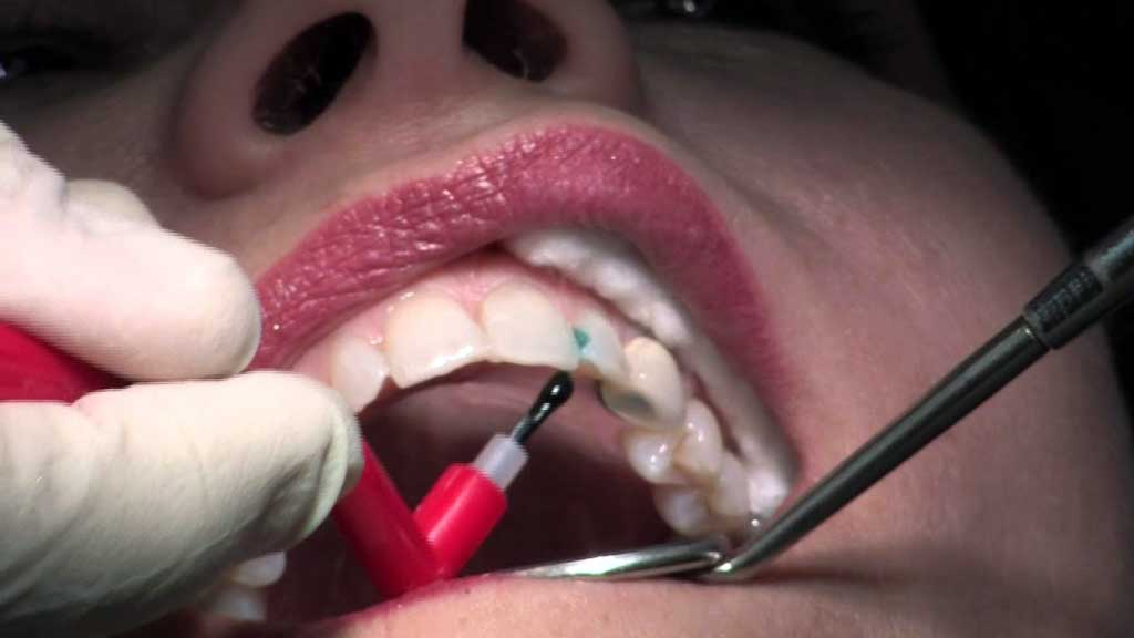 عوارض کامپوزیت دندان