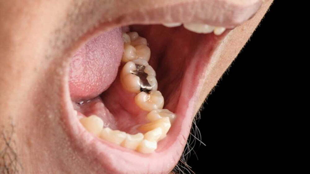 آمالگام دندانپزشکی