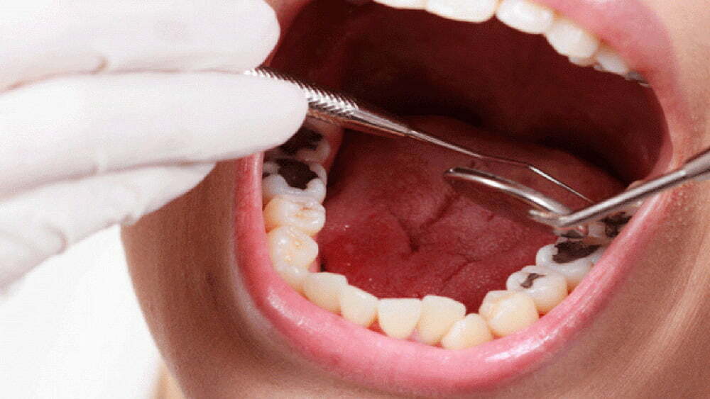 قیمت و خرید آمالگام دندانپزشکی