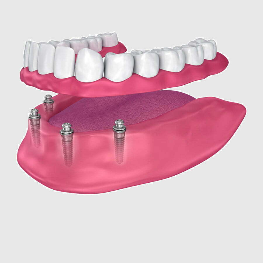 ایمپلنت دندان‌ها