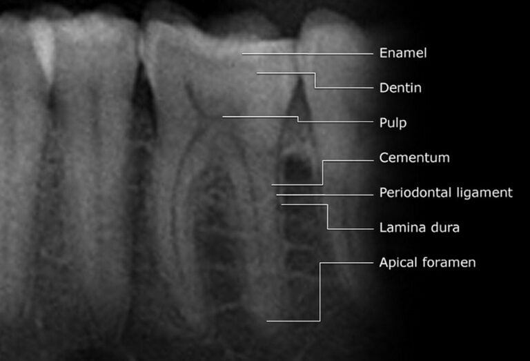 apex locator چگونه به دندانپزشک در تعیین دقیق طول کانال ریشه کمک می‌کند