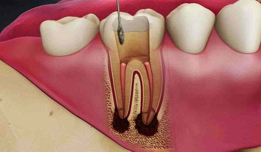 پاکسازی کانال ریشه دندان
