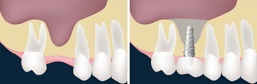 ضرورت انجام پیوند استخوان برای ایمپلنت دندان