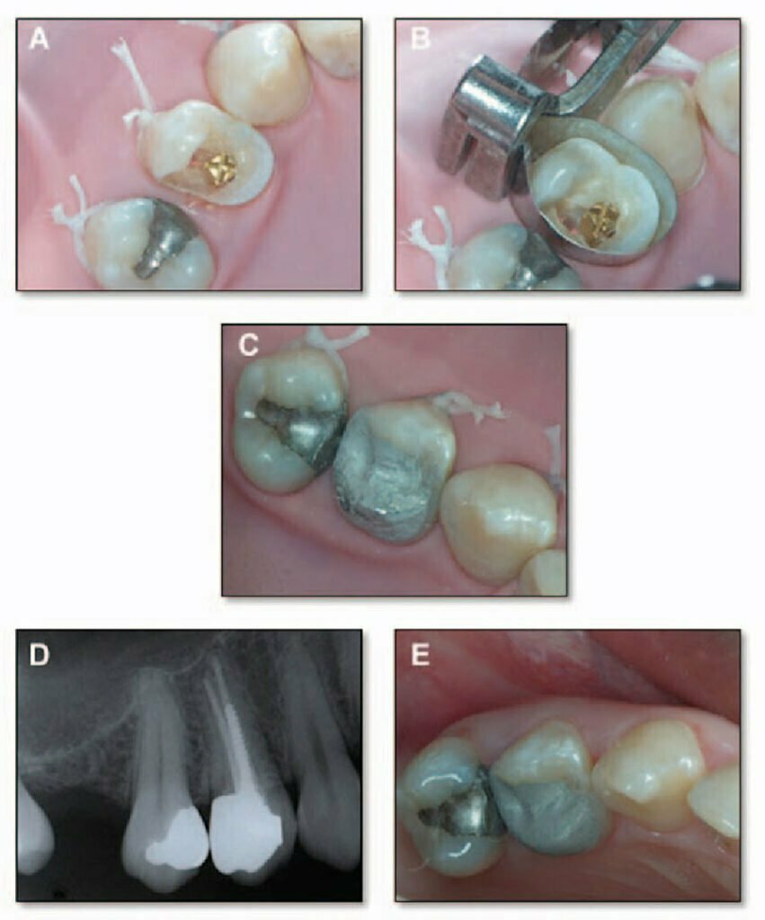 مراحل ترمیم دندان با پین
