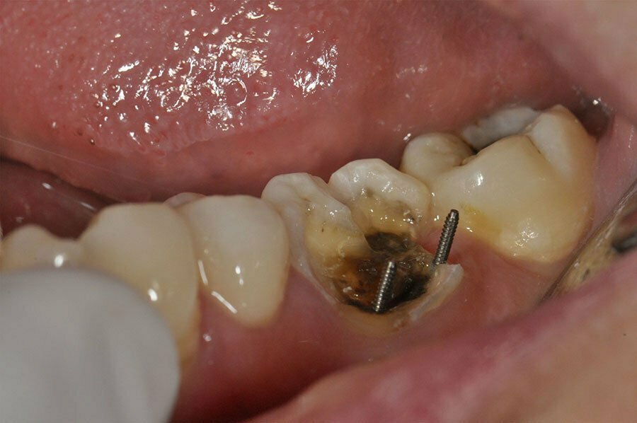 استفاده از پین دندان در ترمیم
