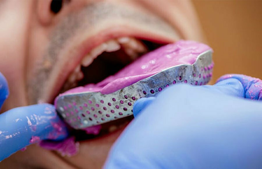 مواد قالبگیری دندان
