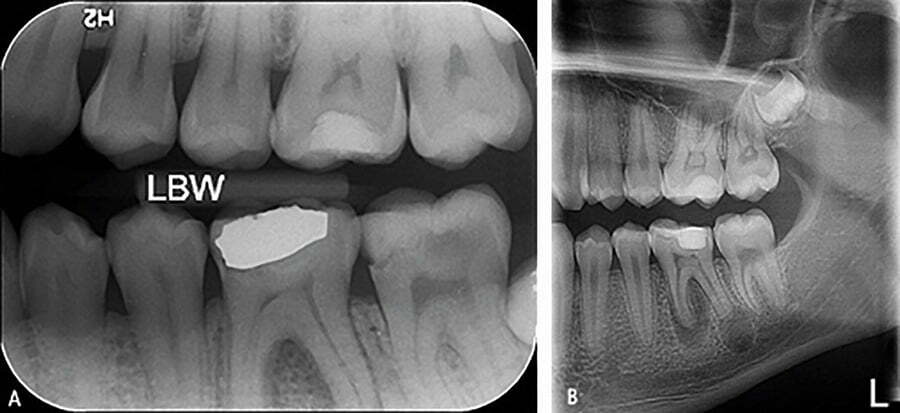 نمونه عکسبرداری از دندان