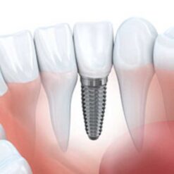 ایمپلنت و جراحی دندان